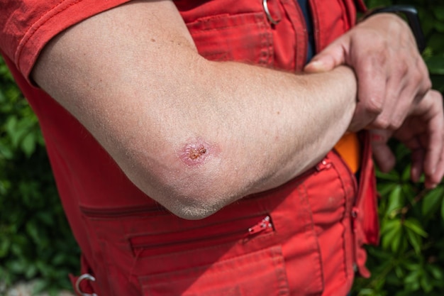 Abrasion Meaning in Tamil